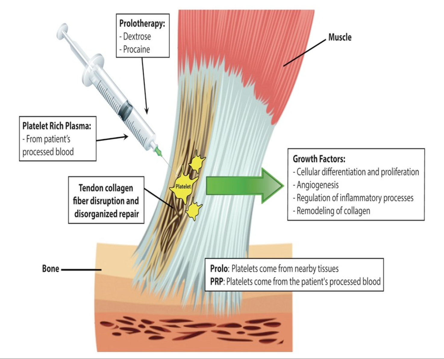 Prolotherapy and PRP in Kelowna, BC Active Care Health Centre